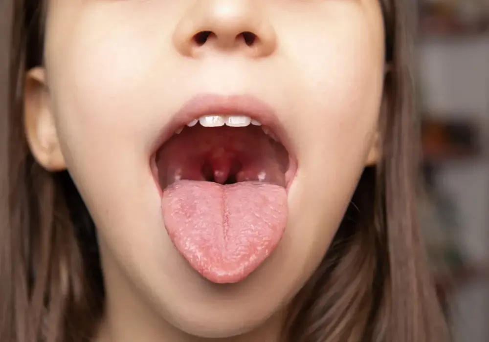 Angina paciorkowcowa u dziecka - objawy, test i leczenie