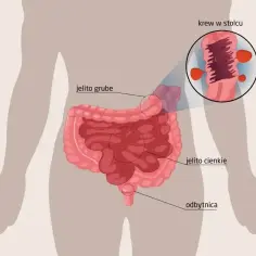 Ilustracja przedstawia jelita z zaznaczonym obszarem jelita grubego, gdzie widoczna jest krew w kale u dziecka.