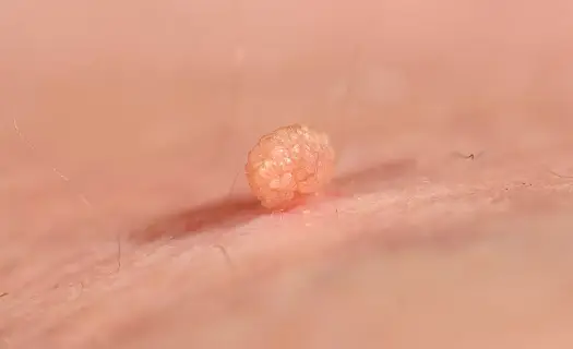 HPV u dziecka - brodawki, objawy i szczepienie