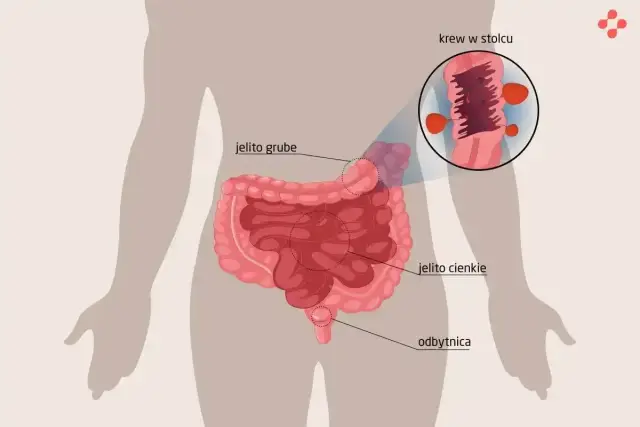 Ilustracja przedstawia jelita z zaznaczonym obszarem jelita grubego, gdzie widoczna jest krew w kale u dziecka.